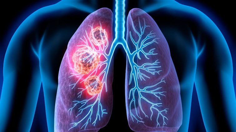 Oncologists discover a growing trend of Lung Cancer among